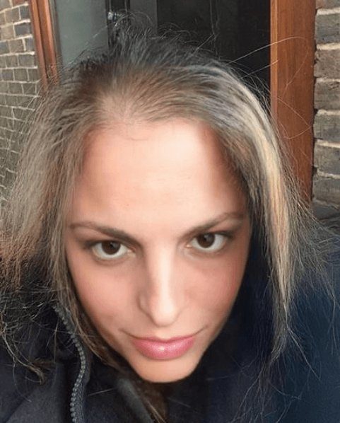 Condição do cabelo com alopecia